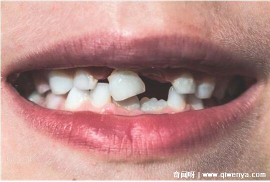 梦里牙齿很难受_梦见牙特别紧是什么意思_