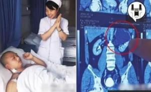 _真实肾脏_世界上肾脏最多的人是谁